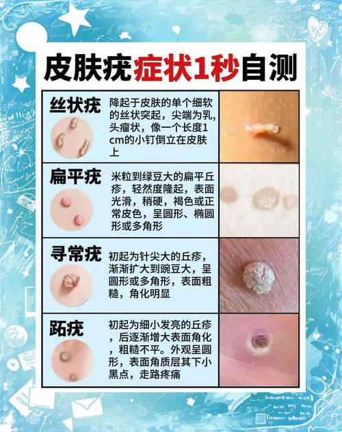 免疫力提升（免疫力提升的话疣会消失吗）